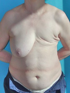 Patient before breast reconstruction using TRAM 
